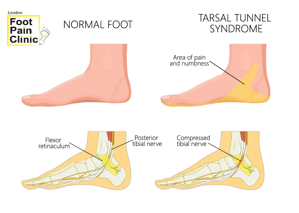 tarsal tunnel pain on inside of ankle treatment wimbledon