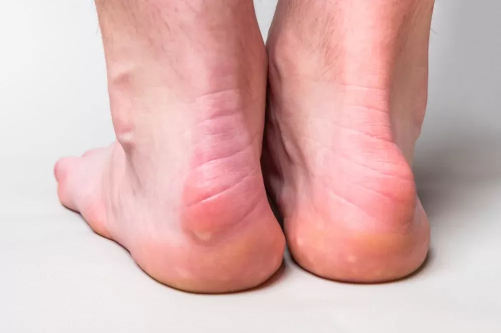 Solutions & Treatments For Haglund's Deformity In London